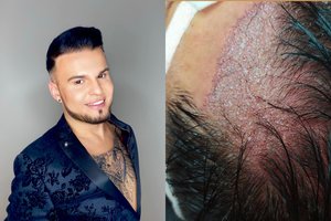 V. Partikas – apie Turkijoje atliktą plaukų transplantaciją: parodė rezultatą ir įvardijo kainą