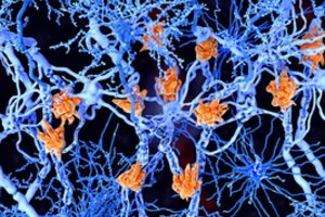 Nepagydoma centrinės nervų sistemos liga Lietuvoje serga tūkstančiai: gali būti, kad ją sukelia virusas