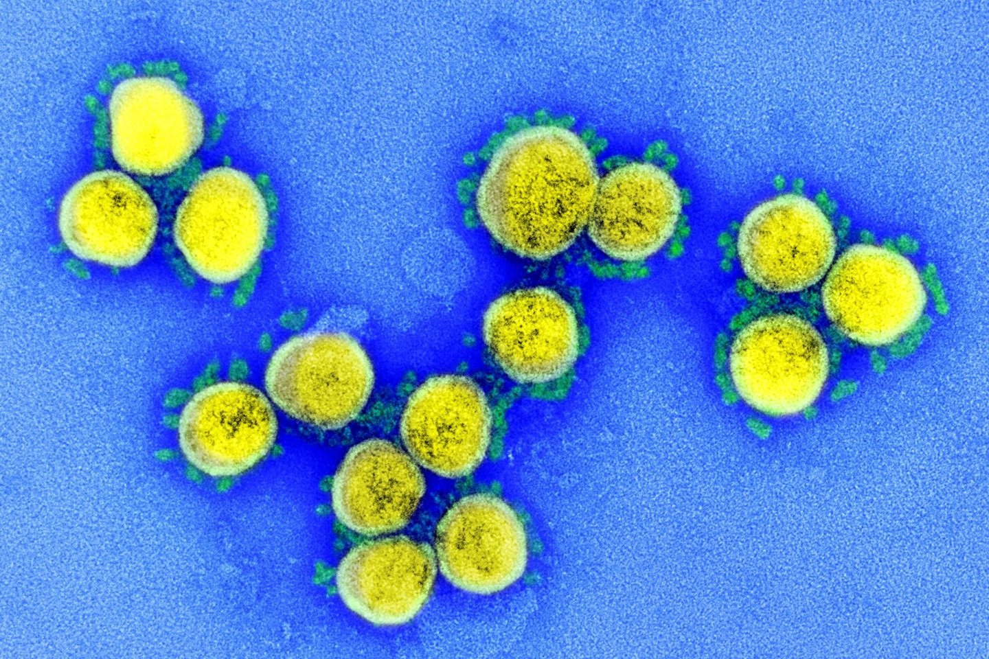  SARS-CoV-2 viruso dalelių, išskirtų iš paciento, elektroninė mikrografija.<br>  NIAID nuotr.