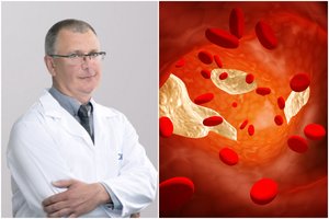 Apie „tylią“ kraujagyslių ligą praneša keli ženklai: juos pajutus chirurgas prašo nedelsti