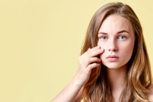 Gydytoja paaiškino, kodėl atsiranda aknės randai ir kaip juos gydyti