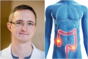 Profesorius pasakė, kokie požymiai gali įspėti apie žarnyno vėžį: suklusti turėtų visi nuo 50 metų
