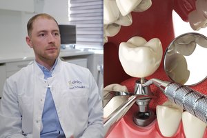 Mitai ir tiesos apie dantų implantus: ar jie gali tarnauti visą gyvenimą?