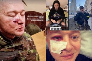 Itin dvasingai Ukrainos liaudies dainą atlikęs karys sužeistas per minosvaidžių ataką: parodė padarinius ir pasiuntė žinutę Rusijai