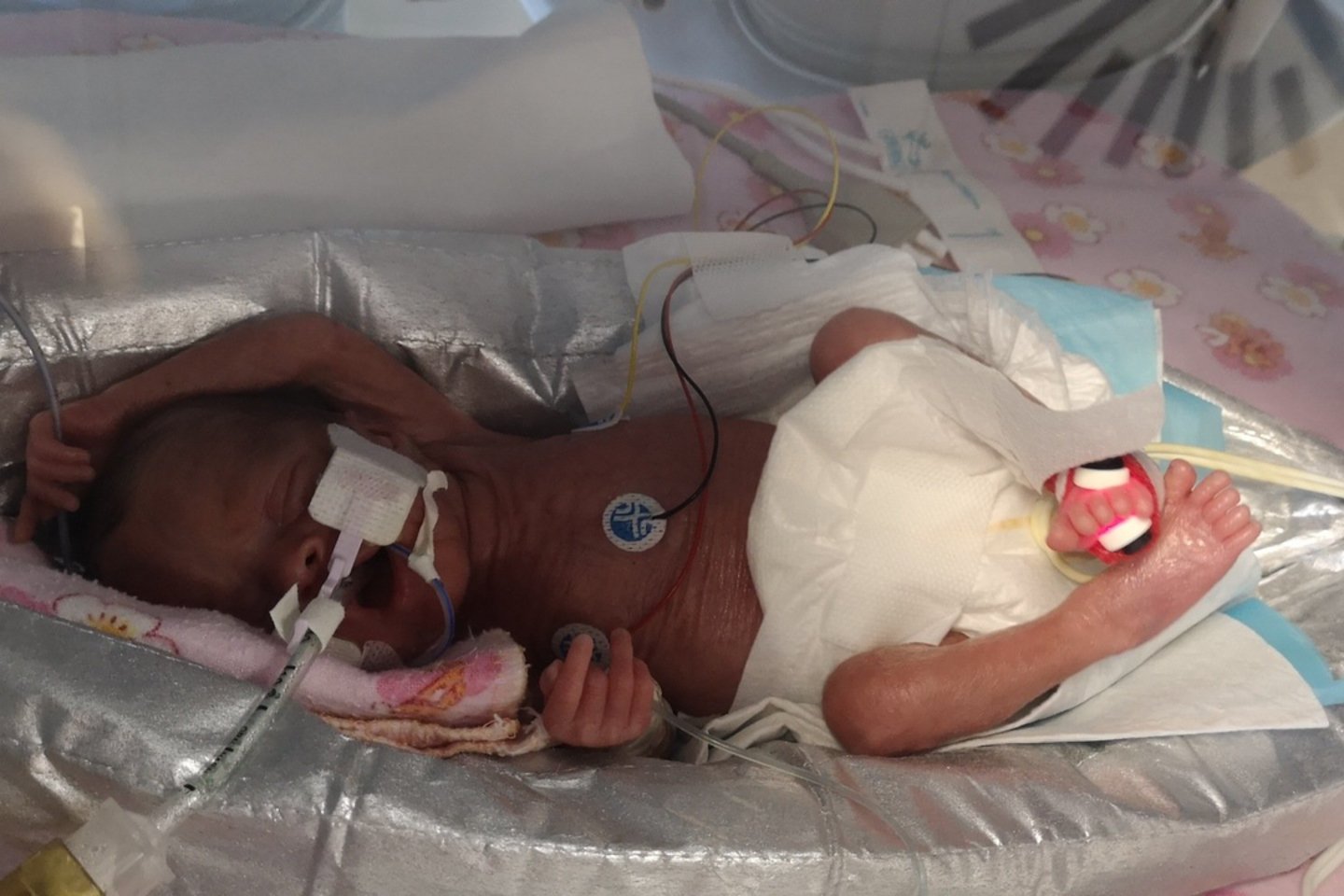  Ankstukė Atėnė ligoninėje praleido tris mėnesius.<br>Asmeninio albumo nuotr.