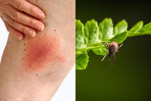 Erkių platinama Laimo liga: 10 klausimų ir atsakymų