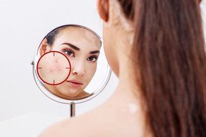 Priemonės, padėsiančios palengvinti akne sergančiųjų kasdienybę