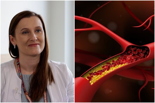Kardiologė: apie tai susimąstyti privalo kiekvienas, turintis padidėjusį cholesterolį – padės išvengti rimtų ligų