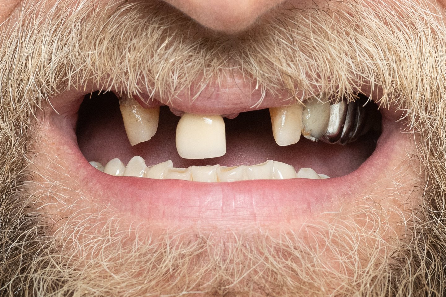 E.Česoniui buvo sudarytas kombinuotas gydymo planas. Pirmiausia pašalinti 8 dantys. Viršutiniam žandikauliui atlikta „Visi ant keturių“ implantacija, kai viso žandikaulio dantys atkuriami vos ant keturių implantų.
