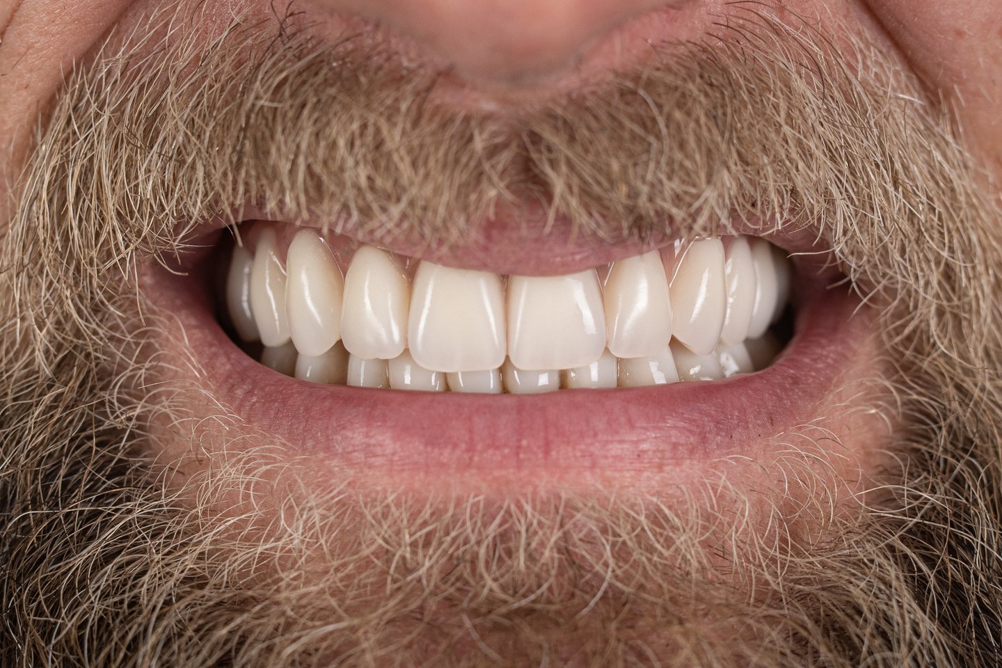 E.Česoniui buvo sudarytas kombinuotas gydymo planas. Pirmiausia pašalinti 8 dantys. Viršutiniam žandikauliui atlikta „Visi ant keturių“ implantacija, kai viso žandikaulio dantys atkuriami vos ant keturių implantų.