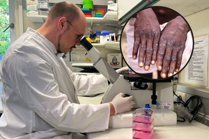 Europoje – nematytas beždžionių raupų plitimas: nustatytas 3 savaičių saviizoliacijos laikotarpis