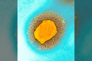 Kas dabar žinoma apie beždžionių raupus? Mokslininkas paaiškino, kiek verta nerimauti