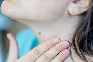 Farmacininkė – apie paprastą apgamų patikros metodą: siūlo patiems atlikti namie