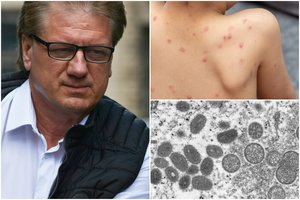 Prof. S. Čaplinskas perspėja, kam pavojingiausi Europoje plintantys beždžionių raupai