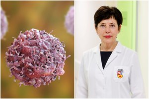 Šiaulietės kūne medikai rado neįprastą auglį: staigi mirtis galėjo ištikti bet kurią minutę