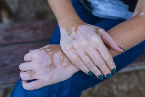 Po nudegimo saulėje – baltos dėmės ant odos: gali byloti apie grėsmingą ligą