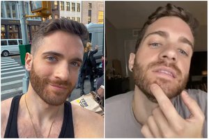 Beždžionių raupais susirgęs aktorius pasidalijo patirtimi: žaizdos atsiveria pačiose netikėčiausiose kūno vietose