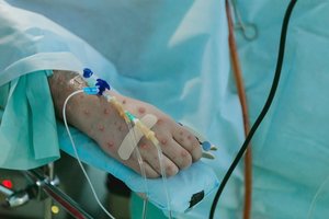 Rusija pranešė nustačiusi pirmą užsikrėtimo beždžionių raupais atvejį