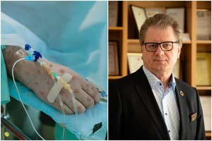 Po griežto PSO sprendimo – S. Čaplinsko įspėjimas dėl beždžionių raupų: panašu, kad virusas įgijo naują savybę