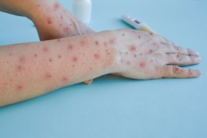 Vokietijoje nustatytas pirmasis vaiko užsikrėtimo beždžionių raupais atvejis