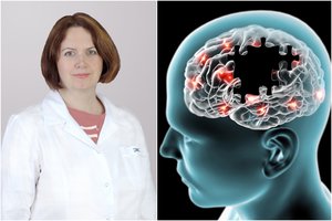 Neurologė įvardijo baisios ligos ženklus, kuriuos dažnas pražiopso: per kelis metus pasiglemžia net jauną žmogų 