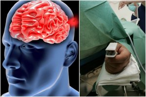 Smegenų kraujagyslė – tarsi tiksinti bomba: apie mirtiną pavojų sužino tik po laiko