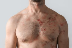 PSO: pasaulyje registruota per 50 tūkst. beždžionių raupų atvejų