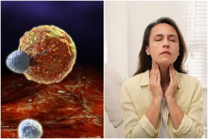 Nuožmus vėžys išsiduoda staiga – pirmasis ligos ženklas matomas plika akimi