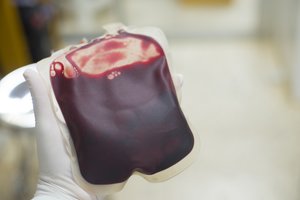 Paaiškėjo, kurią kraujo grupę turintys žmonės dažniau patiria insultą