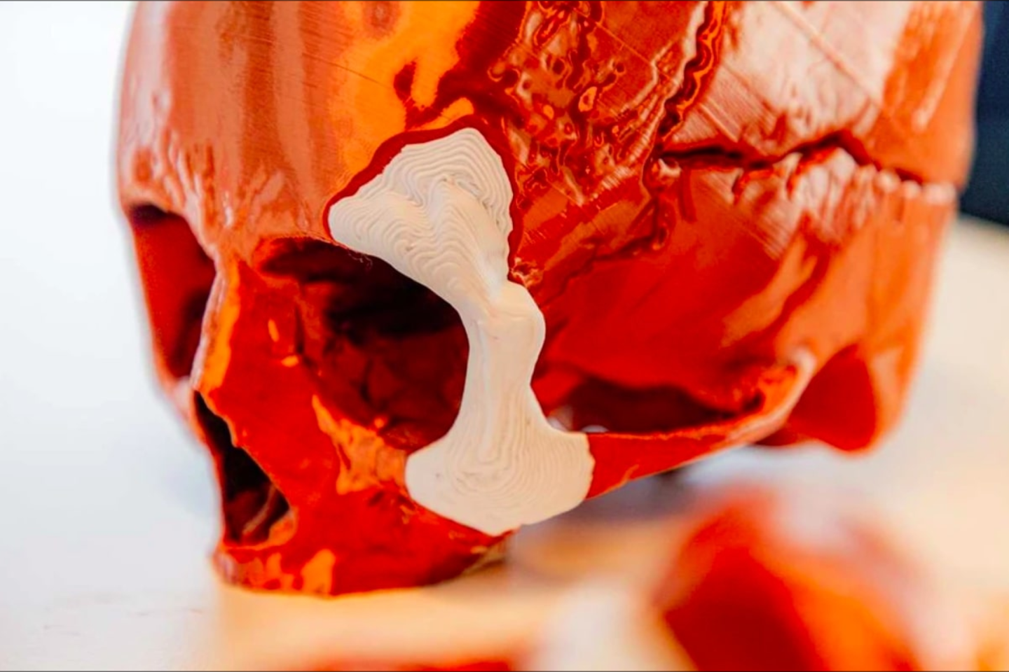  3D spausdintas kaulo implantas.<br> Ossiform nuotr.
