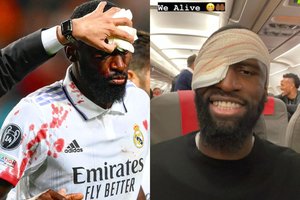 Priešininkų vartininko nokautuotas „Real“ futbolininkas į Madridą grįžo su 20 siūlių veide