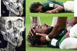 Saudo Arabijos rinktinės vartininkas smūgiu koja vos nenužudė ekipos žaidėjo – skubiai operuotas po lūžusio žandikaulio ir vidinio kraujavimo