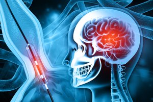 Elonas Muskas: po šešių mėnesių jau turėtume žmogui įsodinti smegenų implantą