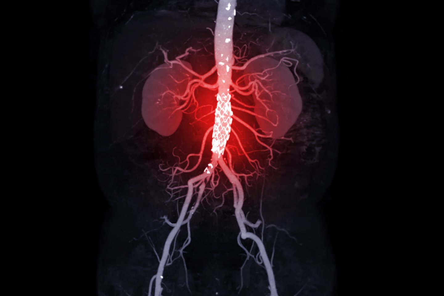 Pilvo aortos aneurizma<br>123rf iliustr.
