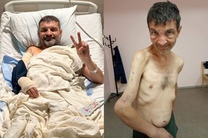 Legendiniam „Azovstal“ gynėjui medikai padovanojo stebuklą – per karą kraupiai deformuota ranka pilnai funkcionuos