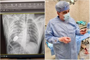 Ukrainoje atlikta itin pavojinga operacija: chirurgas iš kario krūtinės ištraukė bet kada susprogti galėjusią granatą