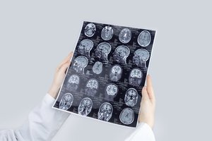 Smegenų vėžys: gydytojas atsakė, kokie ženklai išduoda galvos auglį