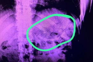 Į Pravieniškių kalėjimą grįžtančio kalinio skrandyje rasta 11 paketų su narkotikais