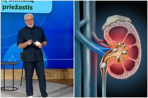 A. Unikauskas atskleidė, kaip kovoti su akmenlige: „Egzistuoja viena stipri priemonė“