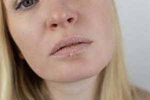 Lūpų sausėjimas byloja apie kelias sveikatos problemas ir svarbių vitaminų trūkumą