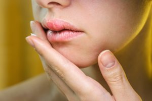 Lūpos gali pradėti skeldėti ir dėl šių trijų vitaminų trūkumo