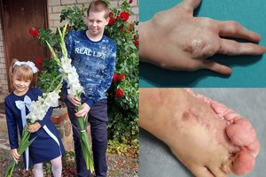 Joniškietis, kurio kūnas deformuojasi, sulaukė šešiolikos: tėvams beliko tik viena viltis