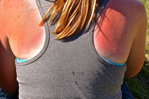 Profesorė pataria, ką daryti nudegus saulėje ir ko vengti