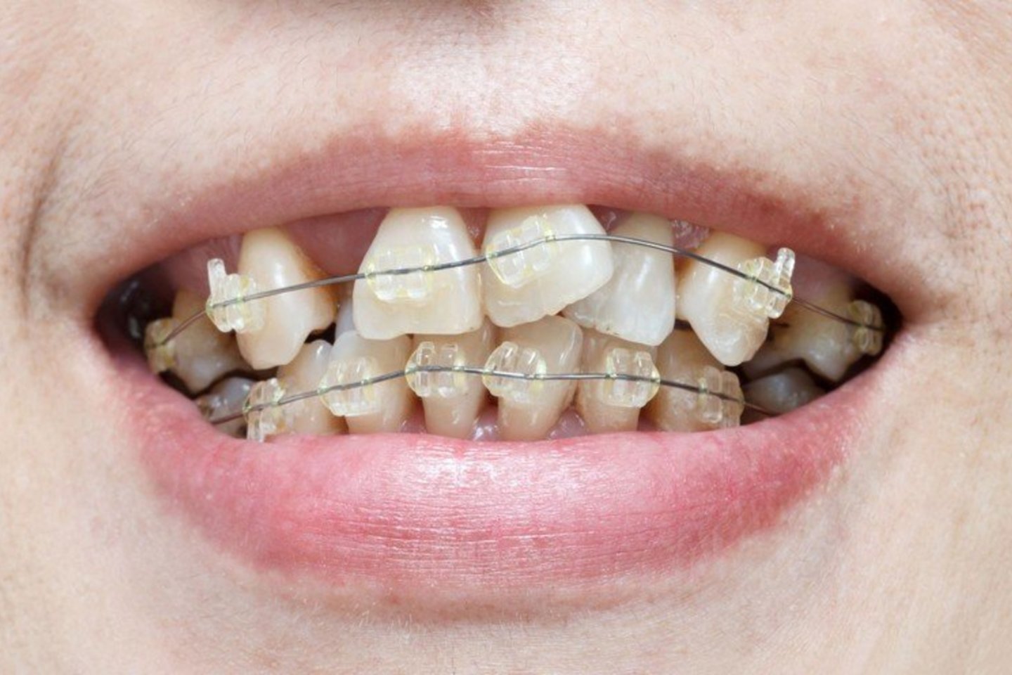 Paskyrus ortodontinį gydymą – breketais ar išimamais aparatais – svarbu skirti ypatingą dėmesį taisyklingai jų priežiūrai.<br>123rf nuotr.