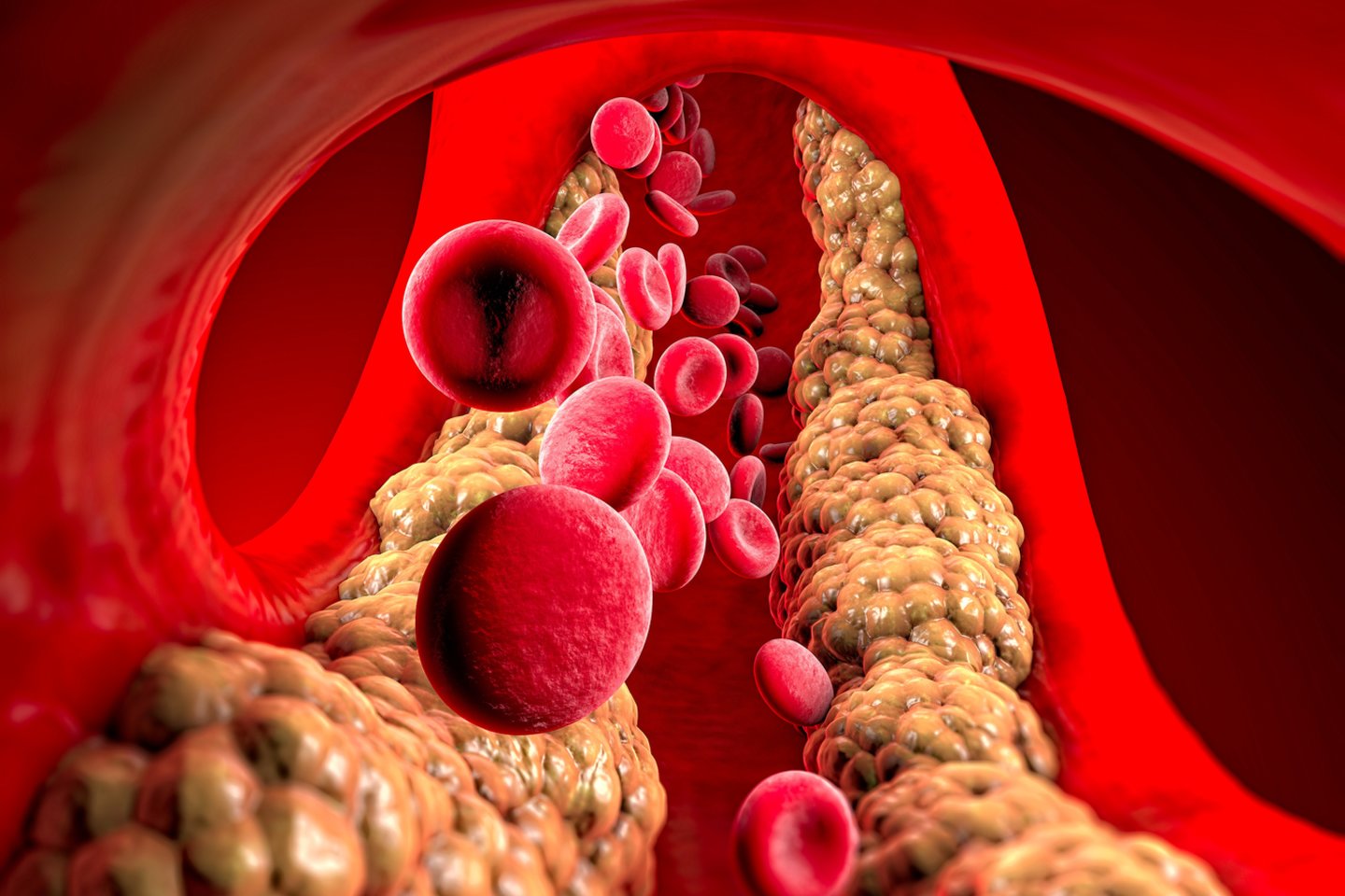  Pagrindiniai arterijų apnašose esantys riebalai yra mažo tankio lipoproteinų cholesterolis.<br> 123rf iliustr.