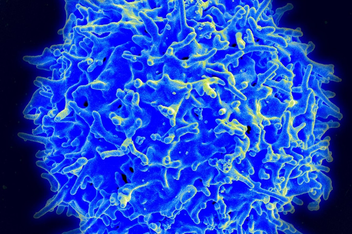  Imuninės sistemos ląstelės – ypač „T“ ląstelės – visada yra aptinkamos arterijų sieneles dengiančiose riebalinėse apnašose<br> Wikimedia commons