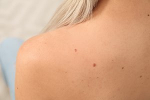 Gydytojas įspėja: apie šį kancerogeną susimąstome per retai