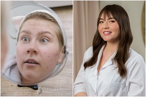 Vasarą padažnėja aknė – specialistė patarė, kaip jos išvengti