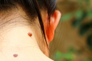 Odos vėžys: kaip apgamus pasitikrinti patiems