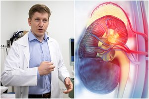 Gydytojas inkstų akmenis naikina be skausmo: jie iš organizmo patys pasišalina